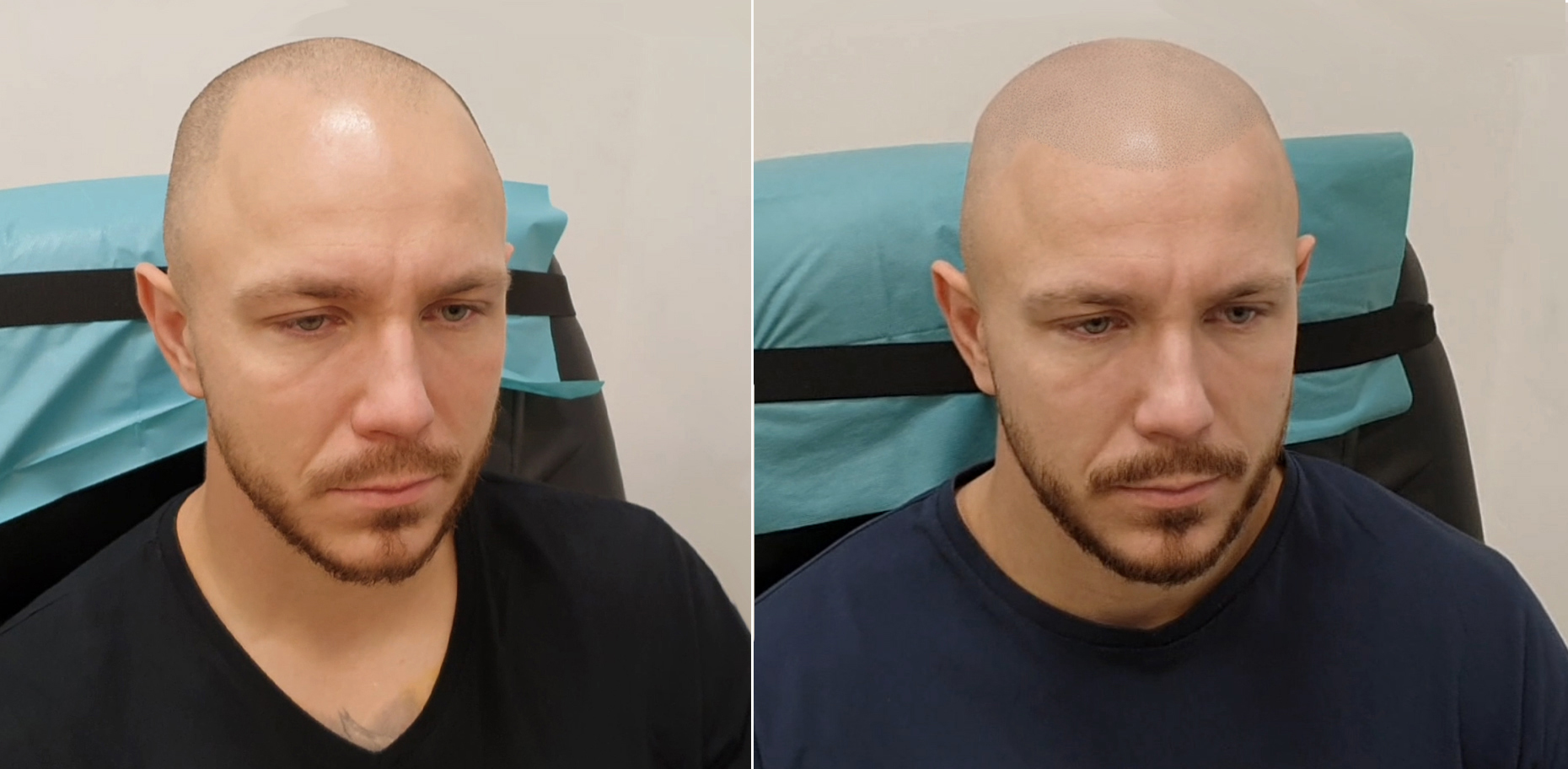 Tetování vlasů mikropigmentace fotografie