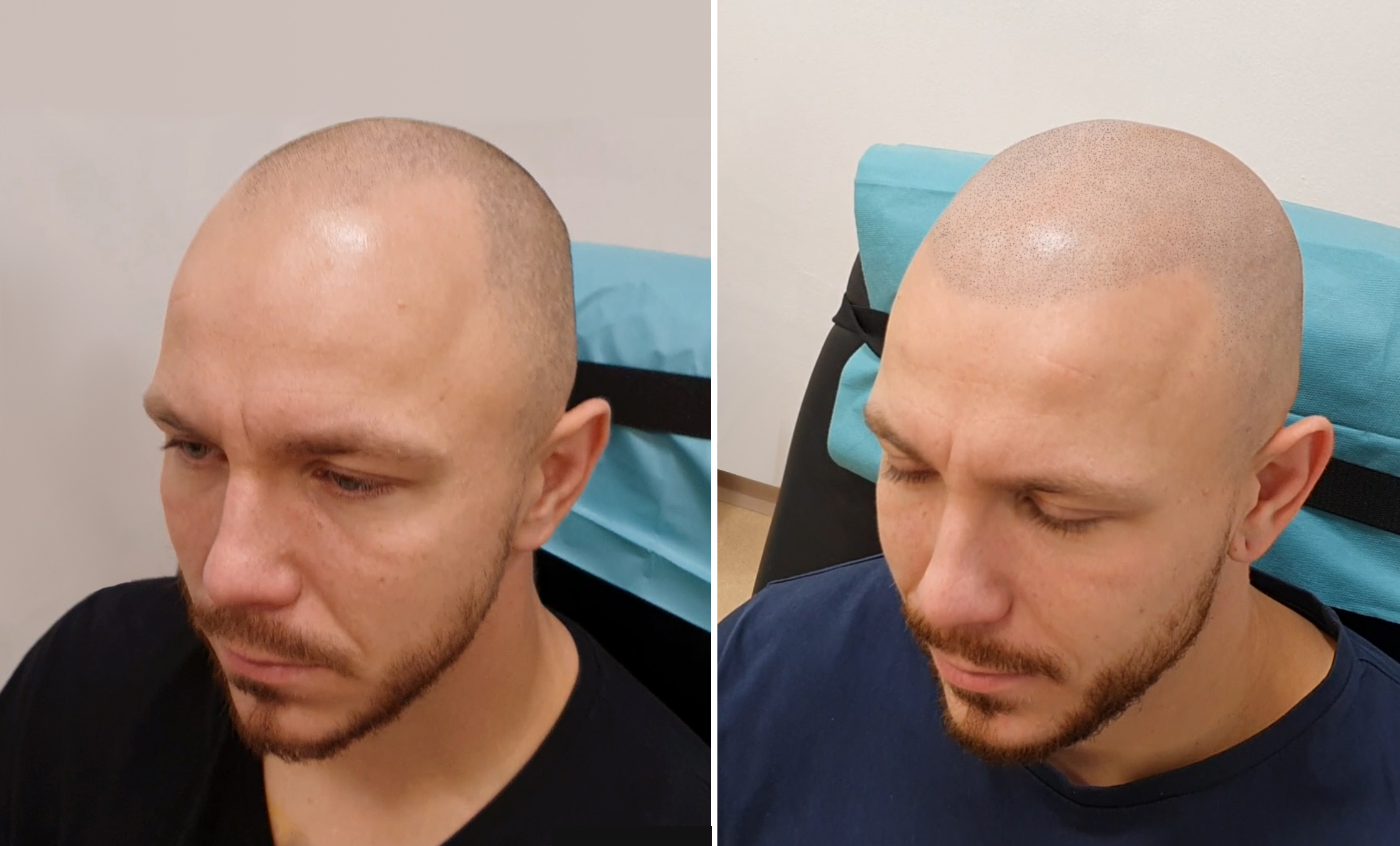 Tetování vlasů mikropigmentace fotografie