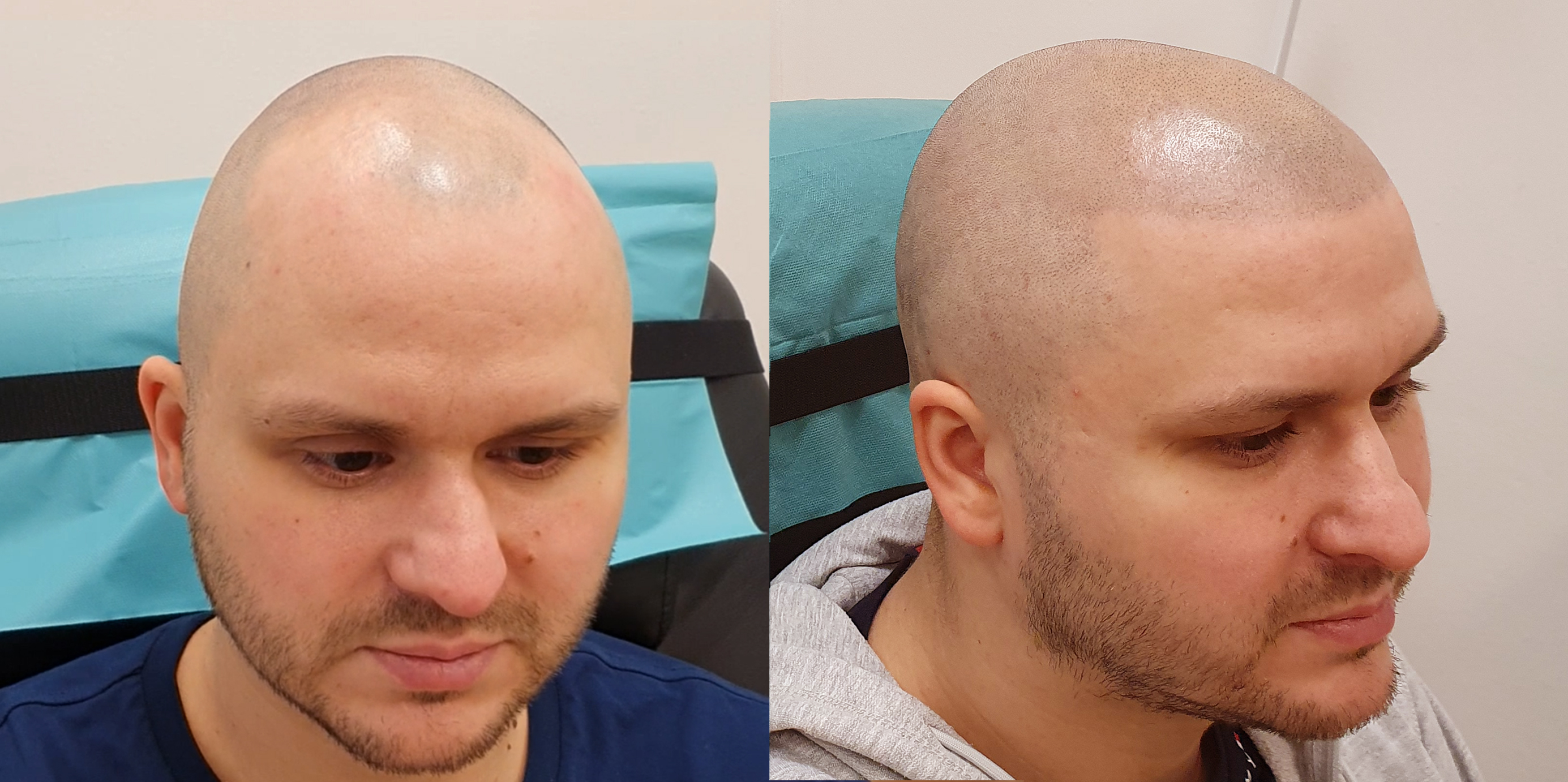 Tetování vlasů mikropigmentace fotografie