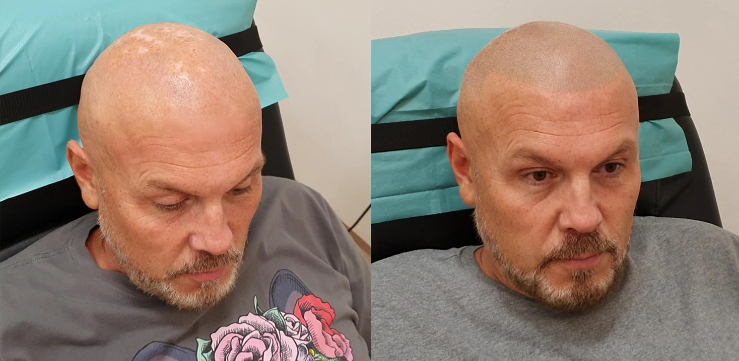 Tetování vlasů mikropigmentace fotografie