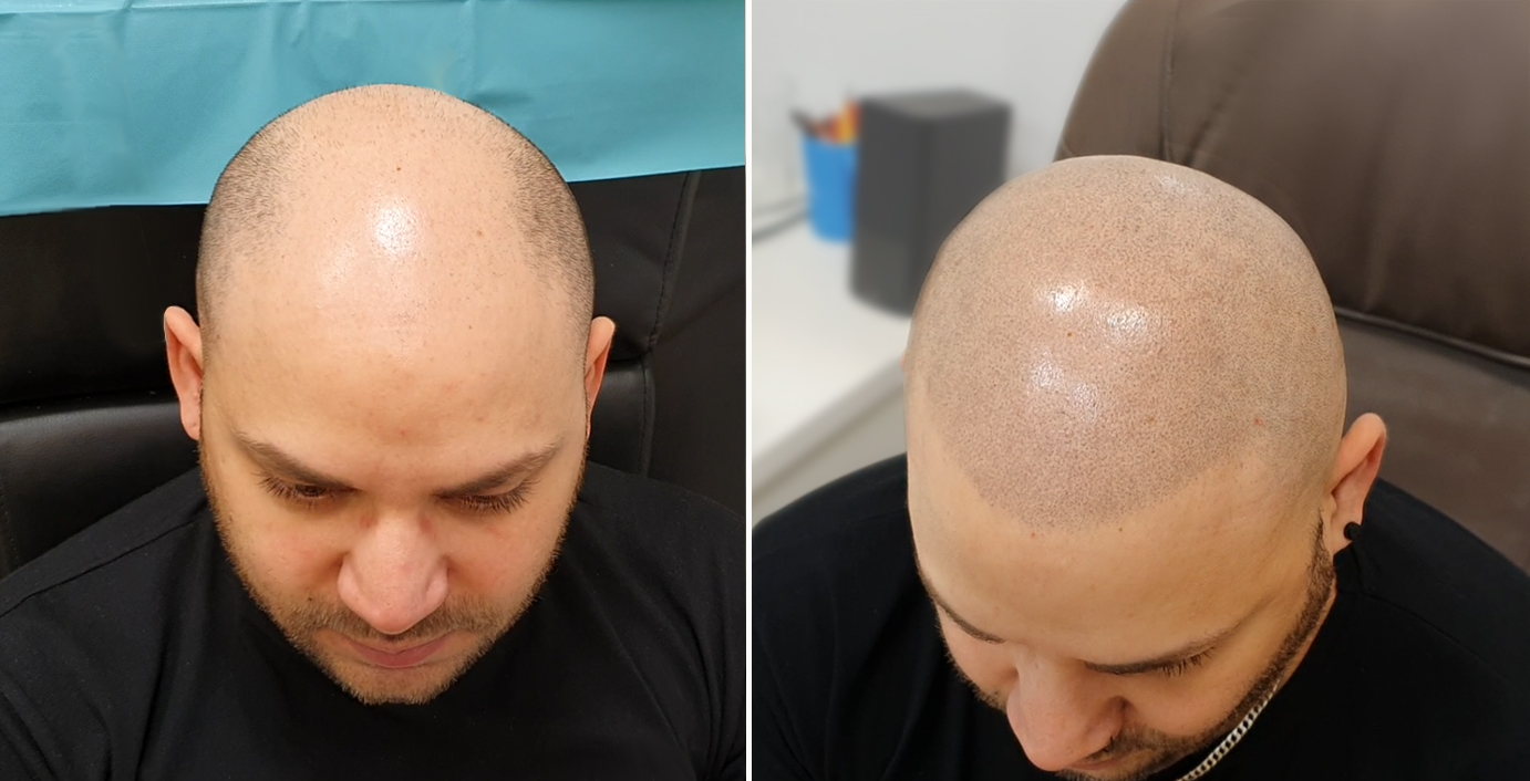 Tetování vlasů mikropigmentace fotografie