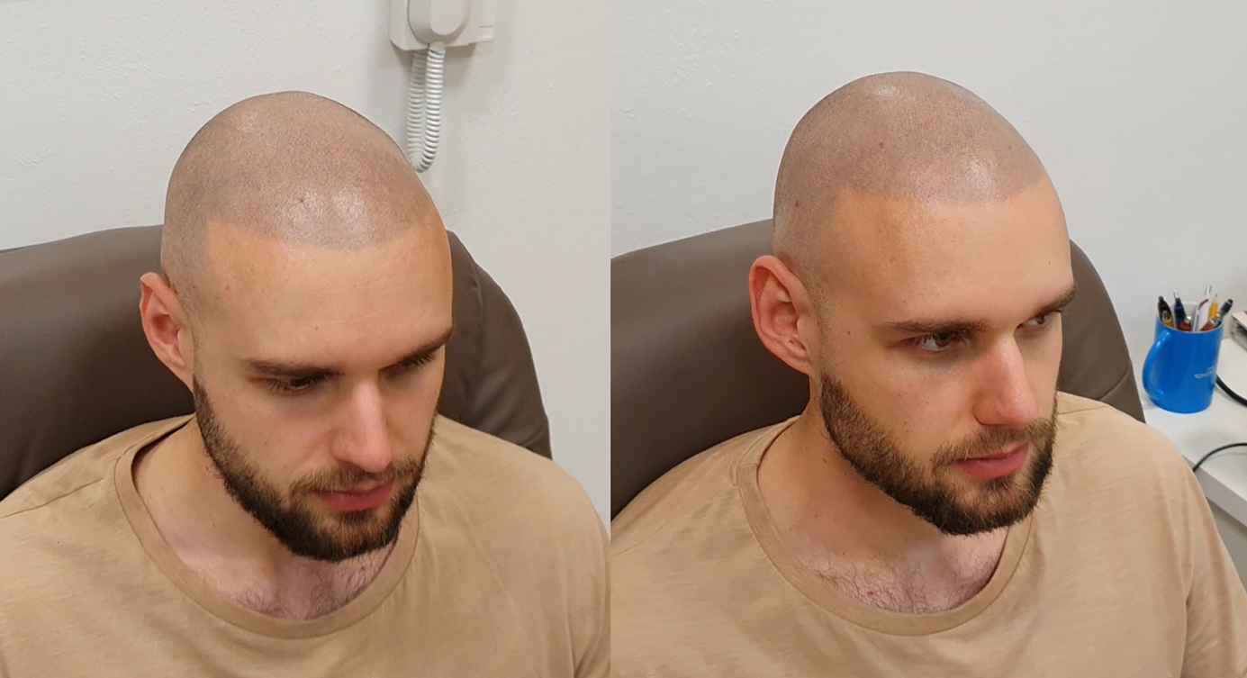 Tetování vlasů mikropigmentace fotografie