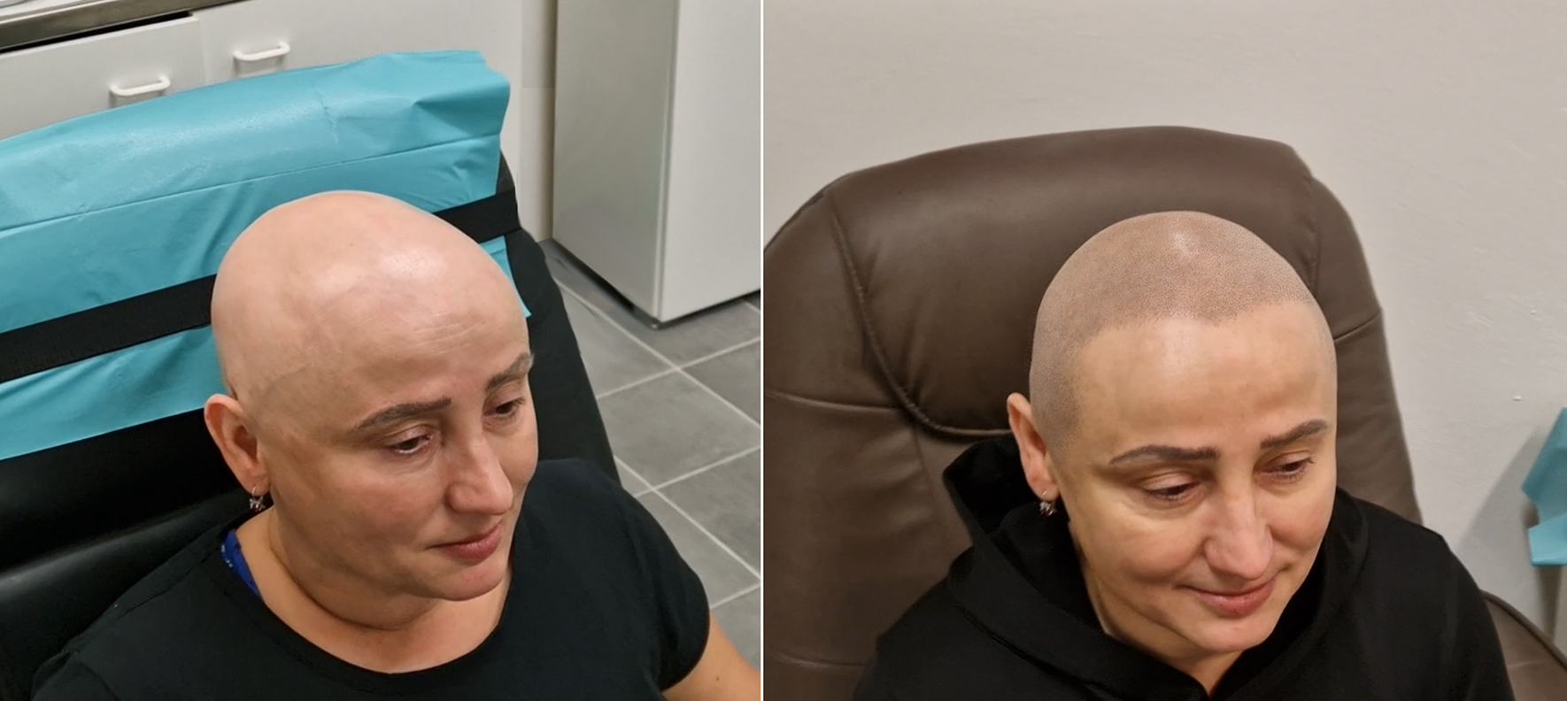 Tetování vlasů mikropigmentace fotografie