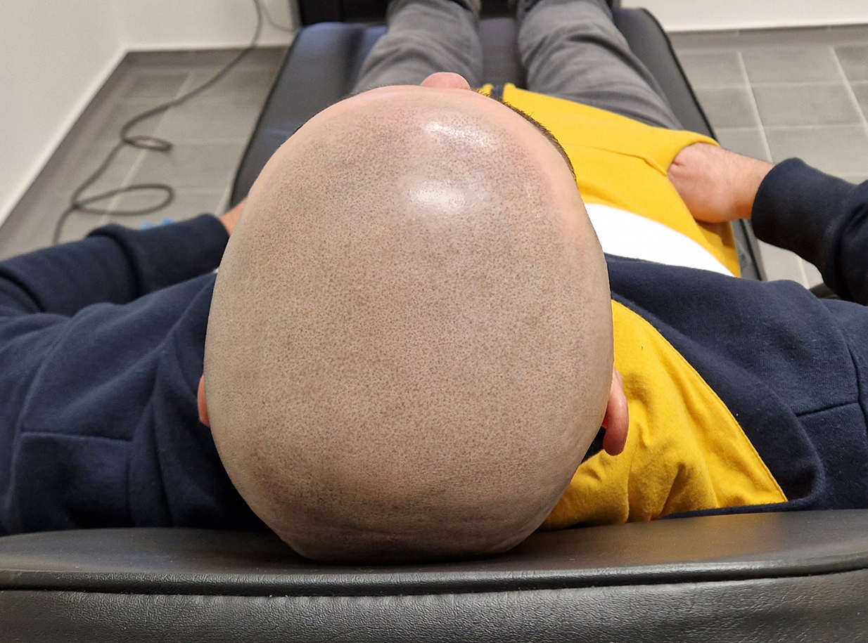 Tetování vlasů mikropigmentace fotografie