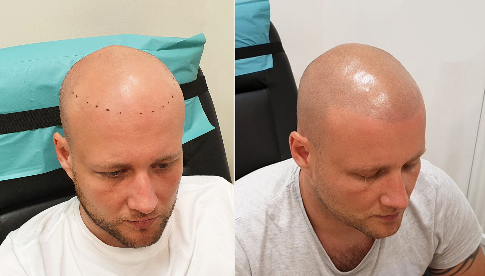 Tetování vlasů mikropigmentace fotografie