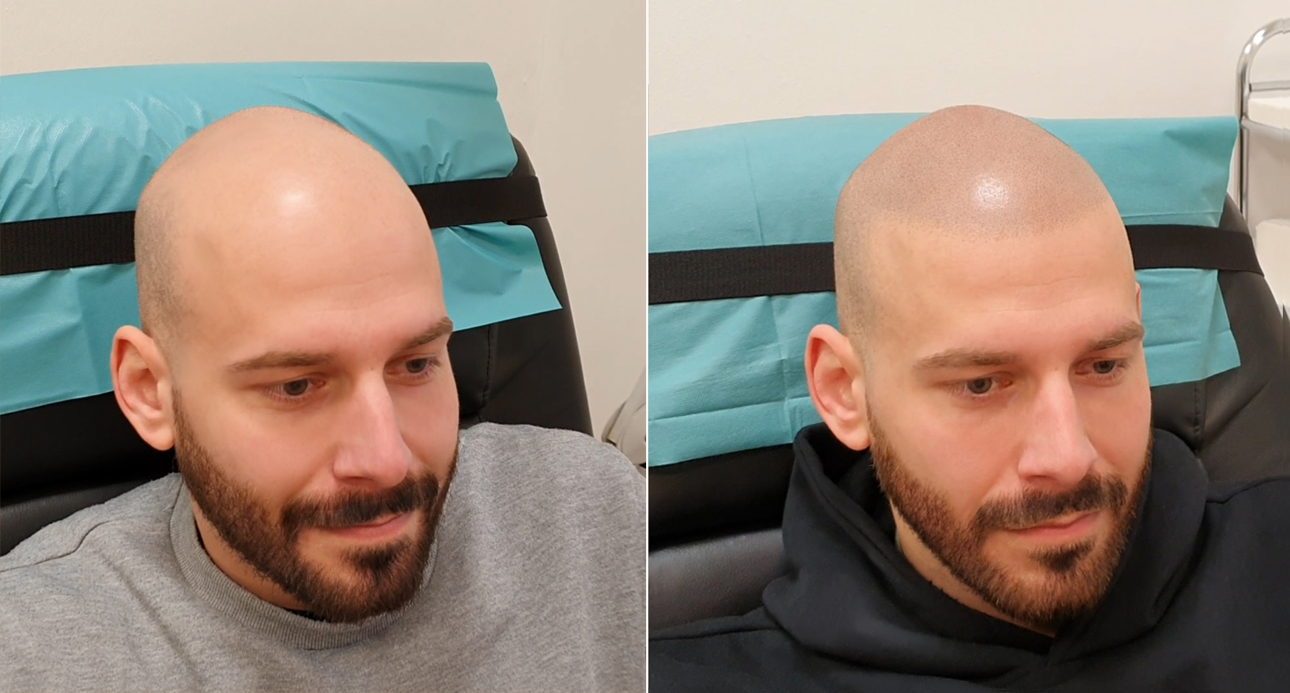 Tetování vlasů mikropigmentace fotografie