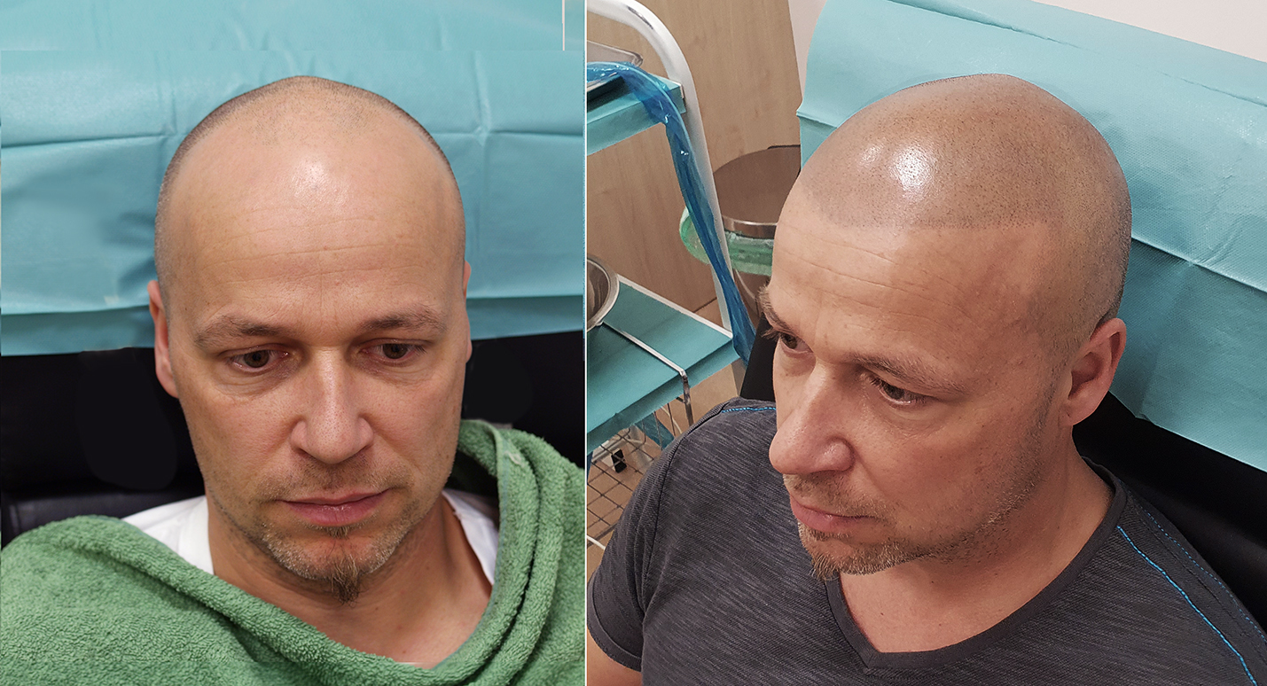 Tetování vlasů mikropigmentace fotografie
